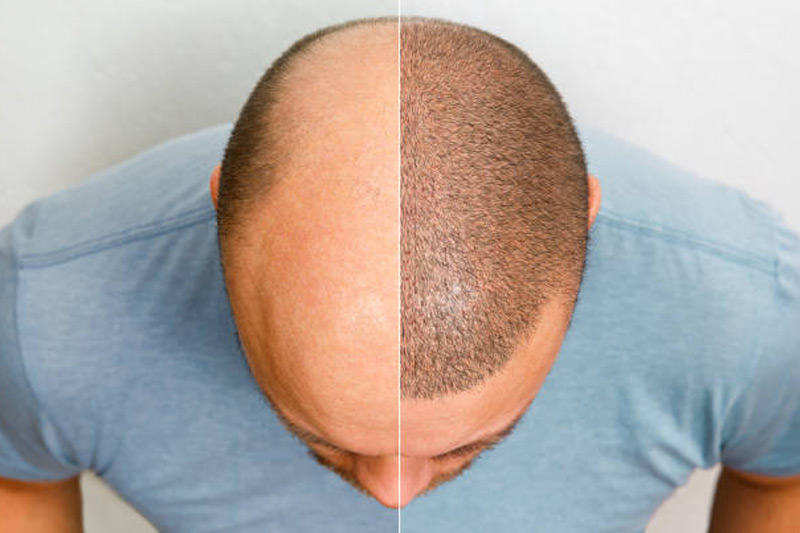 hair-transplant-th1724476024.jpg